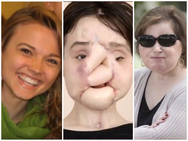 Images: 21-year-old suicide survivor undergoes a historic face transplant