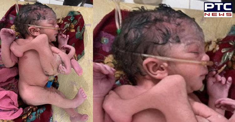 Rajasthan: Four-handed child born in Tonk, see photos