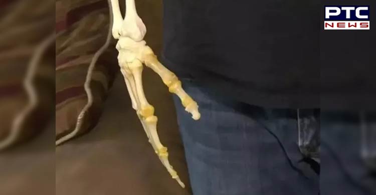 Canada: Man carries around the skeletal remains of his amputated arm [PHOTOS]
