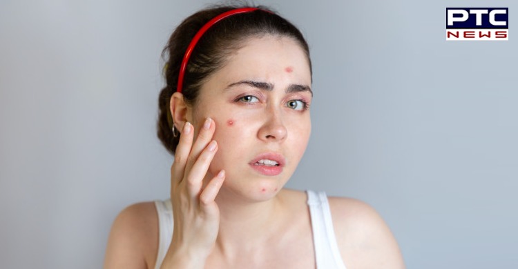 Try these 8 remedies to cure acne overnight