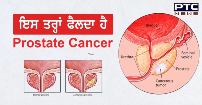 Prostate cancer 1 health : What Is Prostate Cancer ? , prostate cancer symptoms and treatment