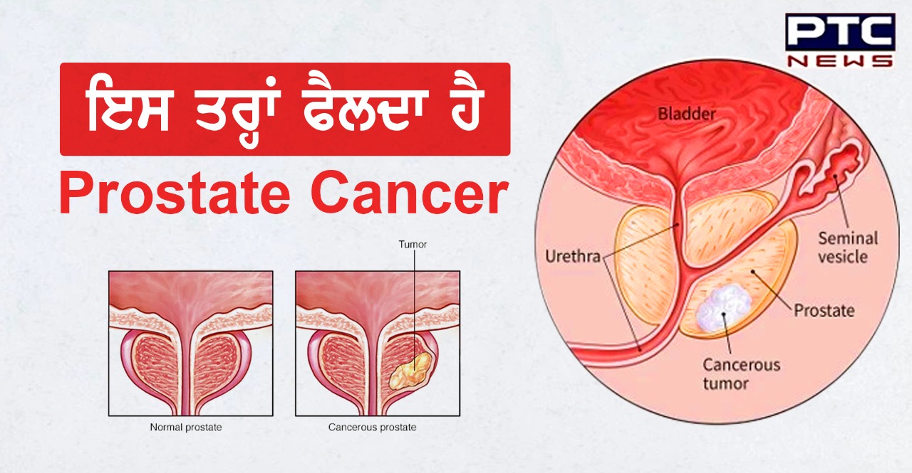 Prostate Cancer : ਇਸ ਤਰ੍ਹਾਂ ਫੈਲਦਾ ਹੈ ਪ੍ਰੋਸਟੇਟ ਕੈਂਸਰ, ਇਹ ਹੁੰਦੇ ਹਨ ਇਸ ਬਿਮਾਰੀ ਦੇ ਲੱਛਣ