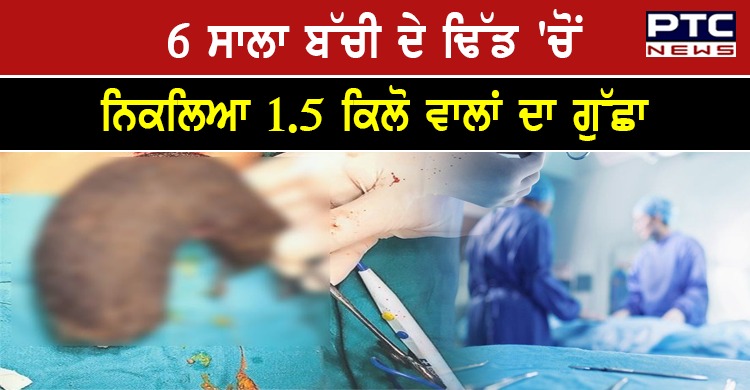 6 ਸਾਲਾ ਬੱਚੀ ਦੇ ਢਿੱਡ 'ਚੋਂ ਨਿਕਲਿਆ 1.5 ਕਿਲੋ ਵਾਲਾਂ ਦਾ ਗੁੱਛਾ, ਡਾਕਟਰ ਵੀ ਹੈਰਾਨ