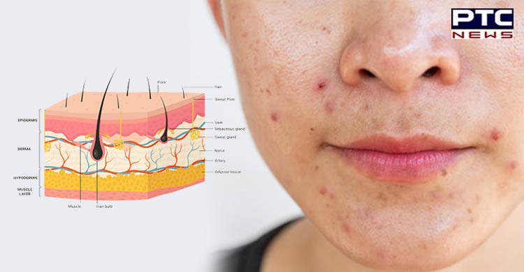 Research finds how fat cells in skin help fight acne