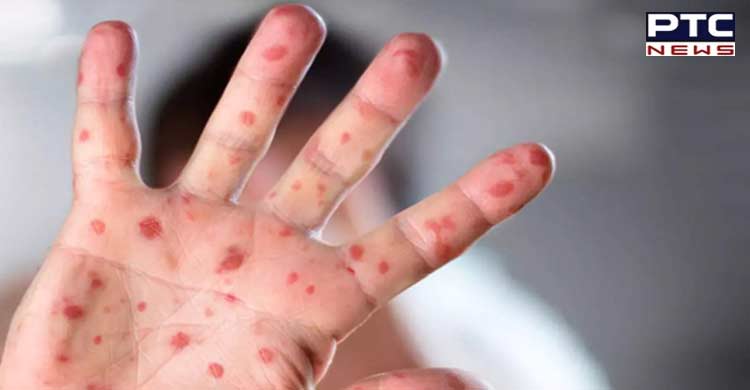 Monkeypox spread in Russia remains high, says WHO