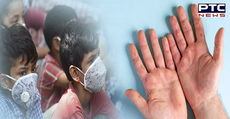 'Tomato flu' scare in Kerala; 80 children found infected