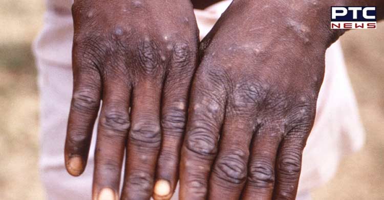 No need to panic, says expert amid monkeypox spurt abroad