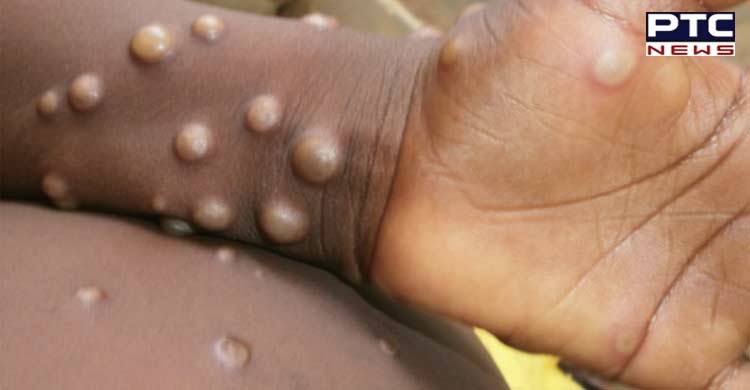 No need to panic, says expert amid monkeypox spurt abroad