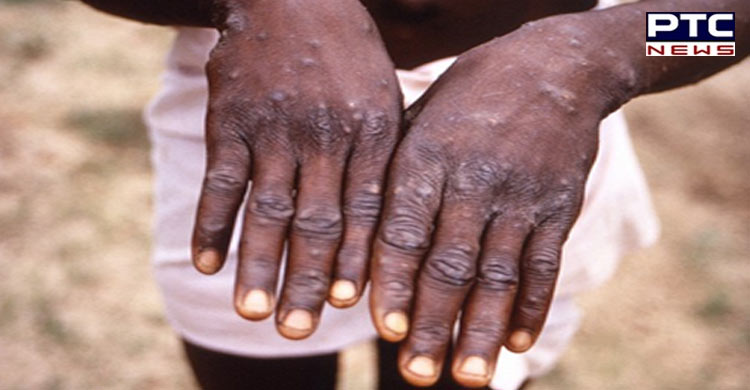 Kerala, July 22: India reported third Monkeypox case in Kerala. 