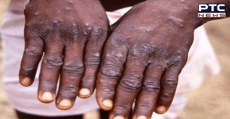 France reports first case of monkeypox