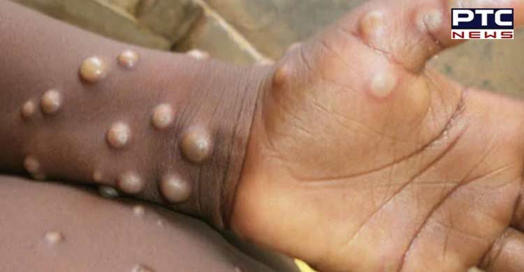 Brazil confirms first monkeypox case