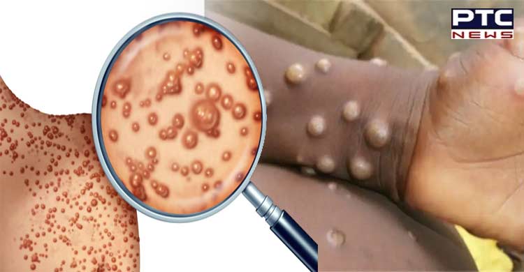 Canada confirms 168 cases of monkeypox