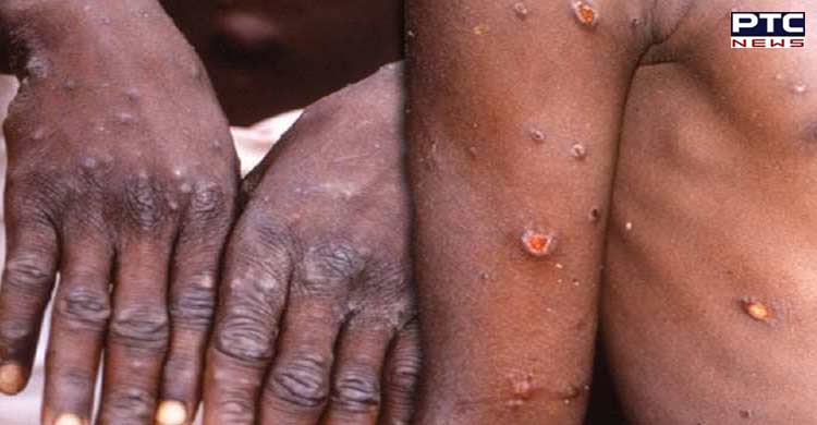 Monkeypox cases in UK surpass 1,000 mark; world total now 3,413