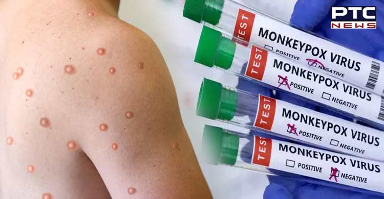 Alert issued after Punjab’s Amritsar reports suspected Monkeypox case