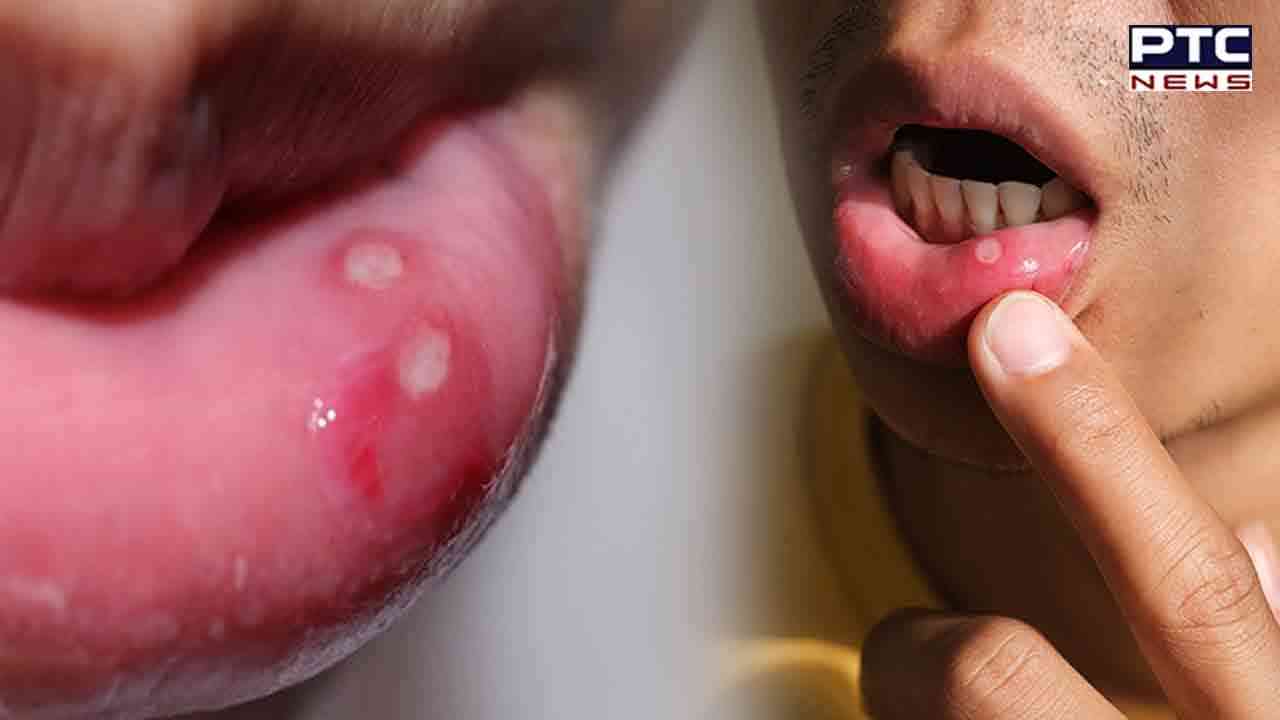 Ulcer in corner of mouth mights be monkeypox