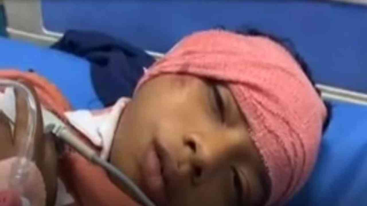 9 साल की बच्ची पर पिटबुल ने किया हमला, चेहरा नोचने के बाद कान को भी काटा